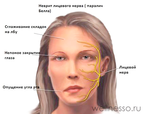 патология лицевого нерва